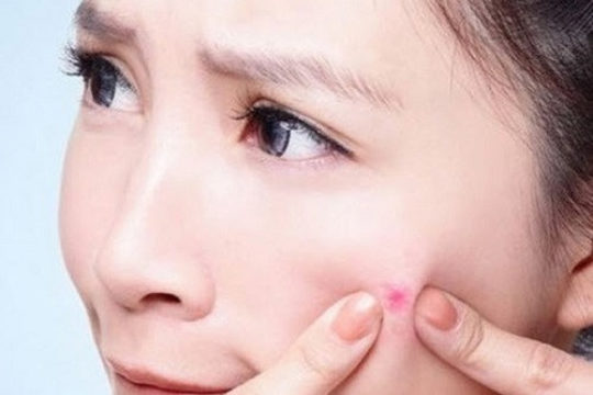 Lấy nhân mụn